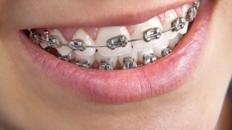 How Effective Is Orthodontics In Teens?