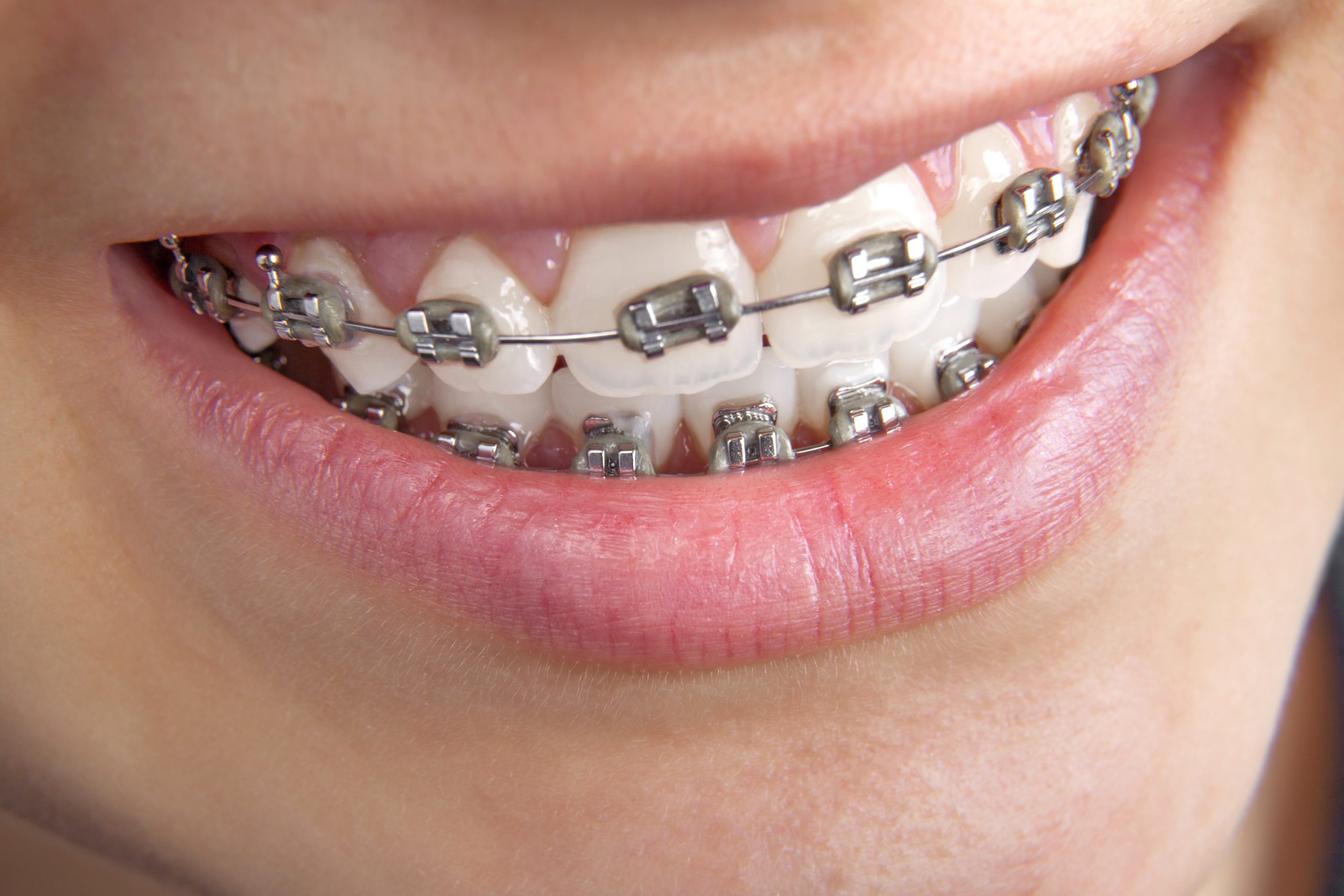 How Effective Is Orthodontics In Teens?
