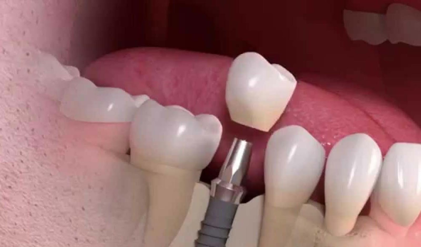 The Process of Dental Implant Surgery 