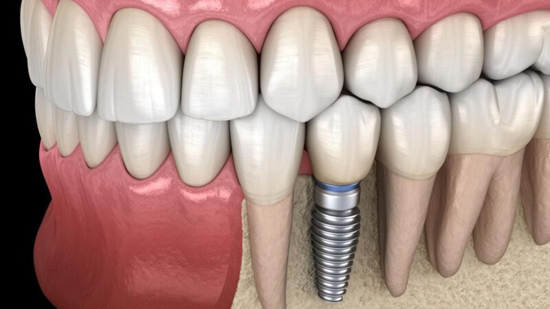 Is a Dental Implant the Best Method to Replace a Missed Tooth?