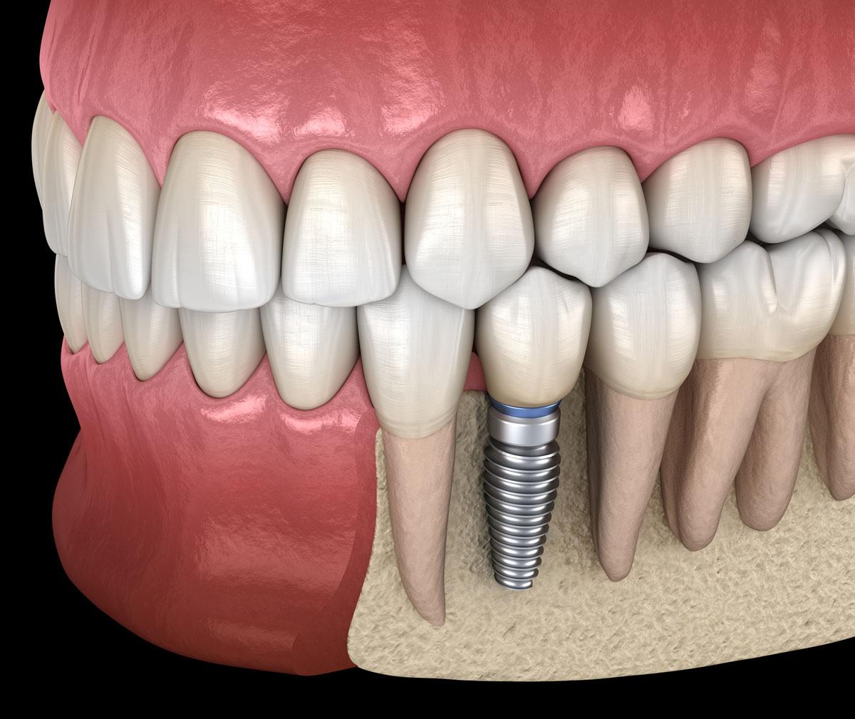 Is a Dental Implant the Best Method to Replace a Missed Tooth?