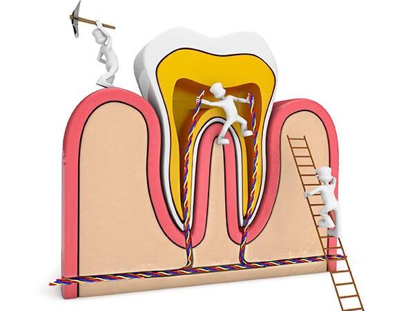 One-Session Root Canal Treatment