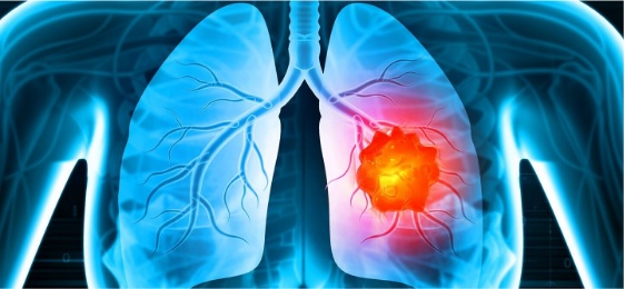 Understanding Lung Cancer Treatment Options and What You Can Expect