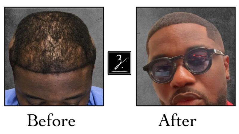 Factors to Consider Before Choosing a Hair Transplant Clinic in London