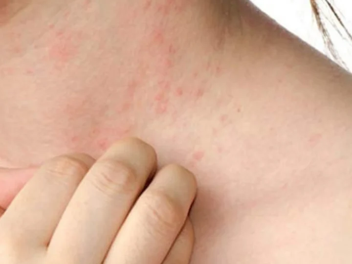 Effective Tips and Remedies for Dust Mite Allergy Relief at Home