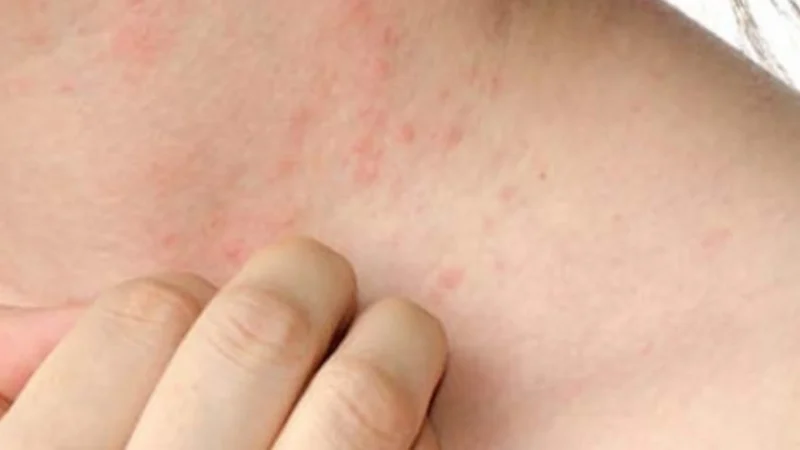 Effective Tips and Remedies for Dust Mite Allergy Relief at Home