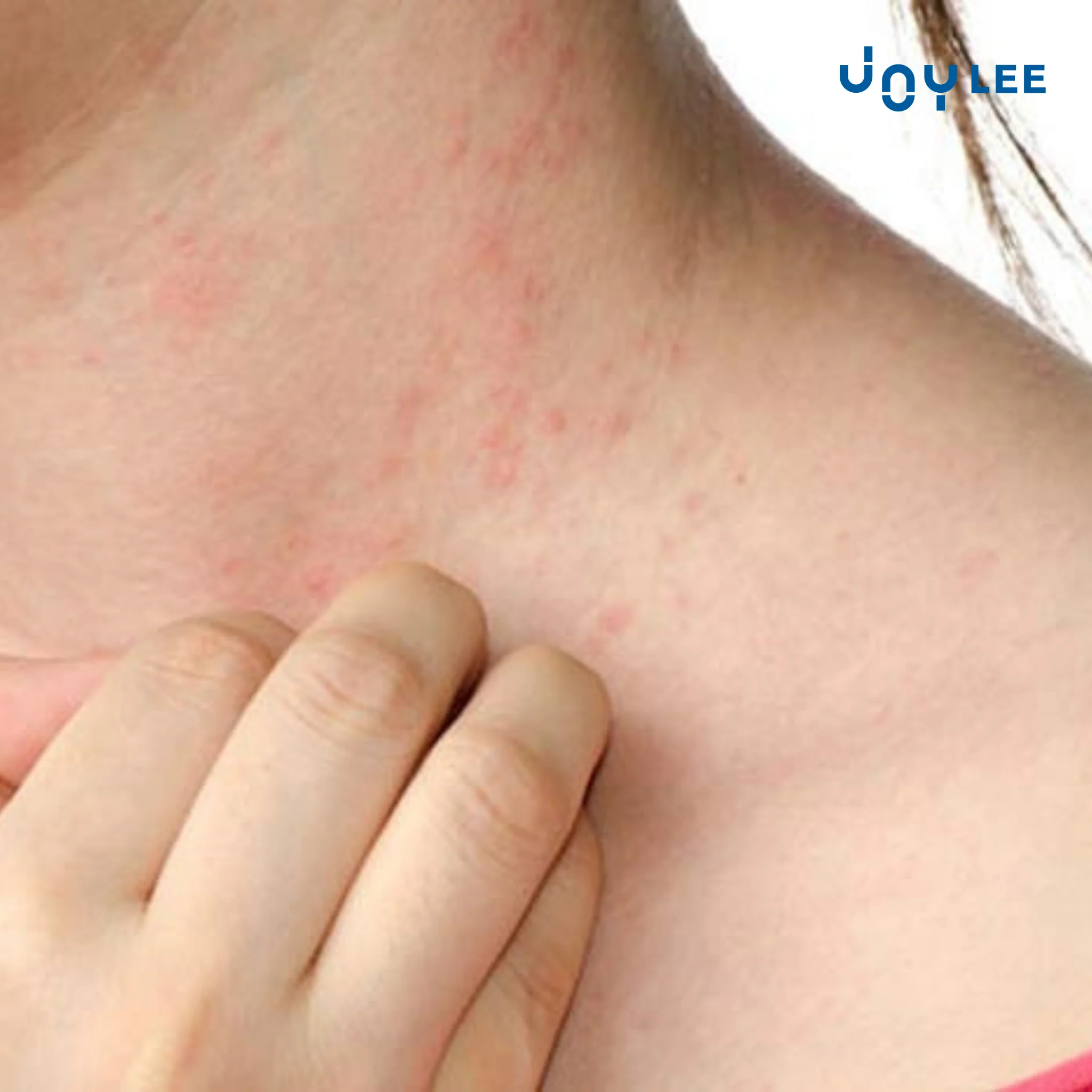 Effective Tips and Remedies for Dust Mite Allergy Relief at Home