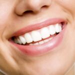 Teeth Whitening