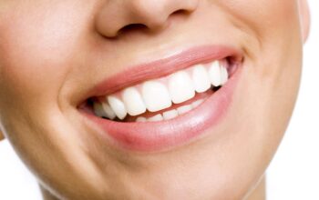 Teeth Whitening