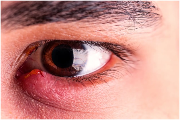 Simple At-Home Stye Relief Without Harsh Chemicals
